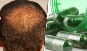 Supplements and Hair Loss